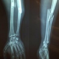 Image of a broken arm, representing how West Virginia personal injury lawyers at Burke, Schultz, Harman & Jenkinson fight for compensation when someone else caused your injury.